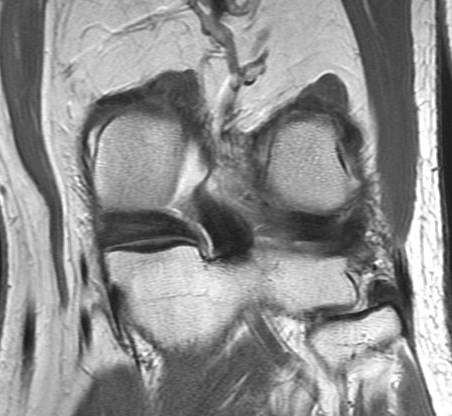 Figure 4 for case Root attachment tear of the posterior horn of the lateral meniscus (RID2763)